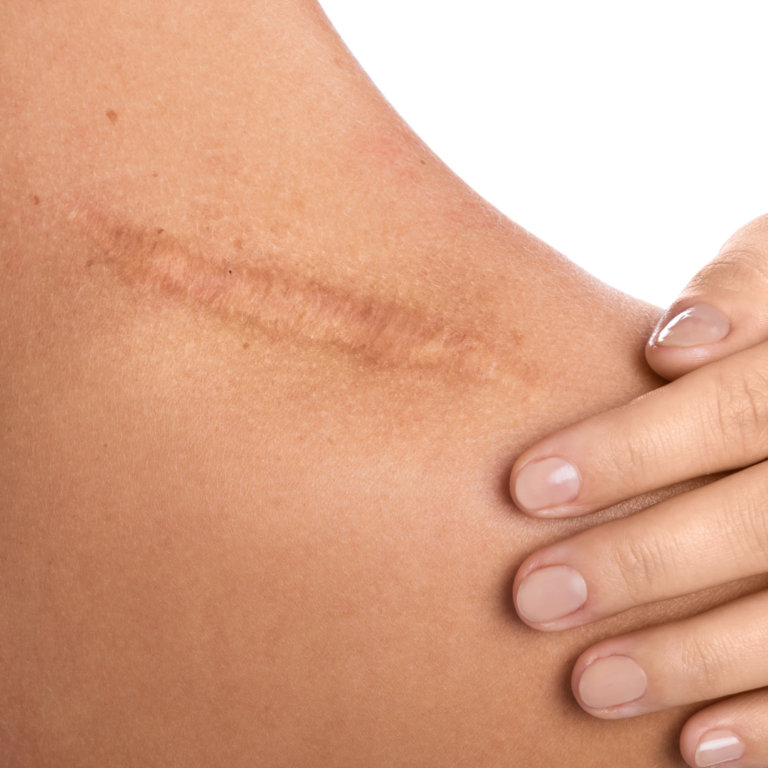 Massage Therapy to Reduce Scars