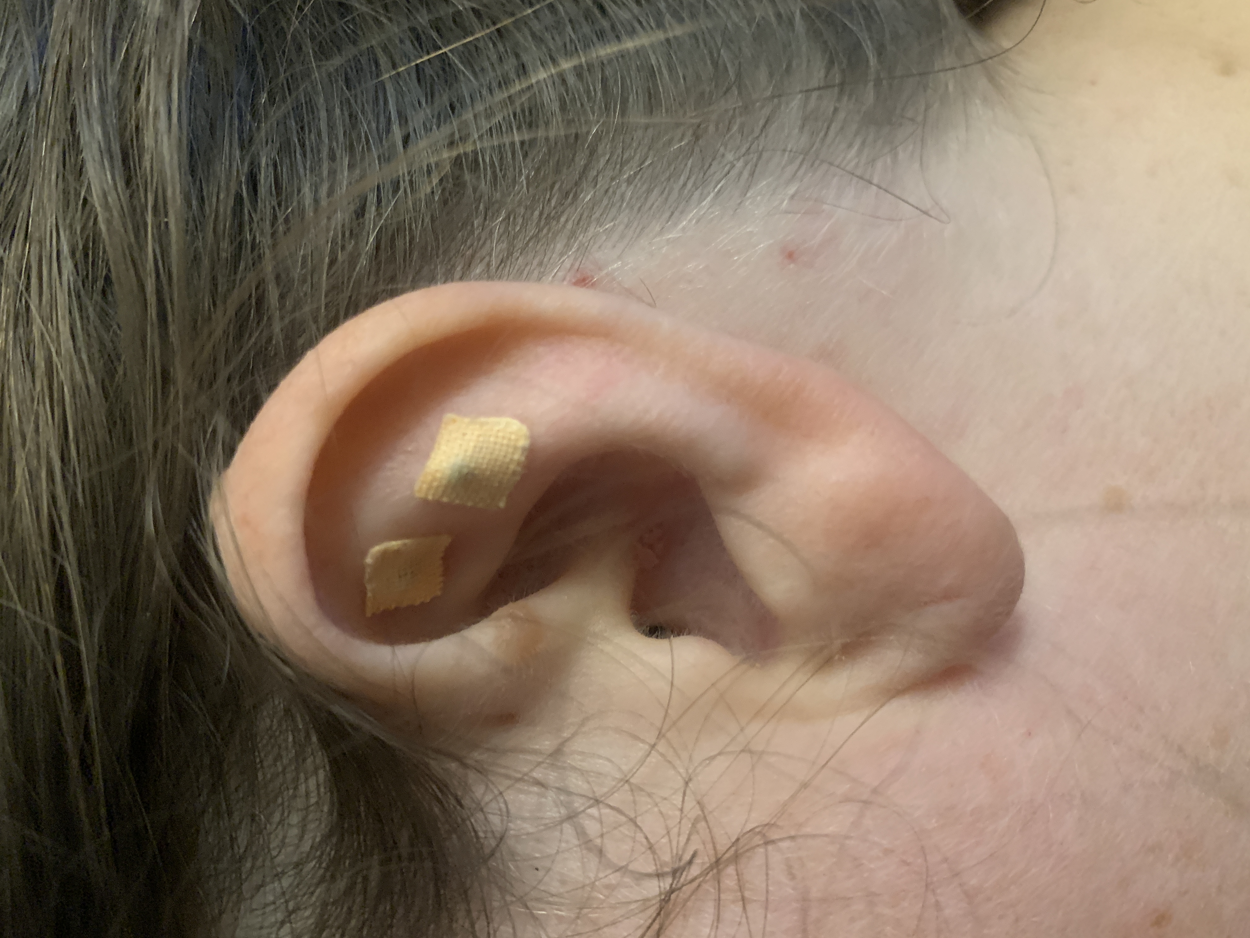 Ear Seeds May Help a Number of Conditions